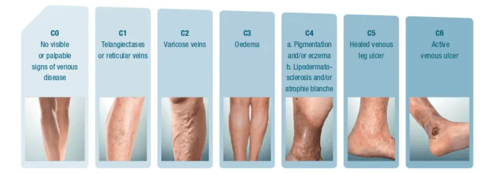 Signs You May Have Chronic Venous Insufficiency